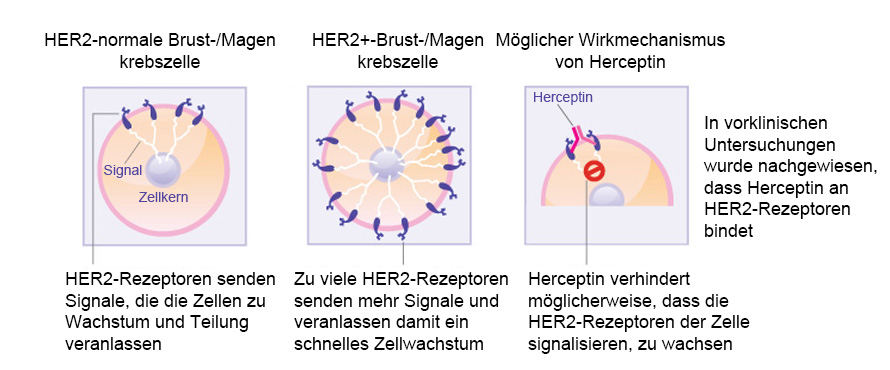 Wie Herceptin auf Brustkrebszellen wirkt. (Quelle: Siehe Verweis 1)